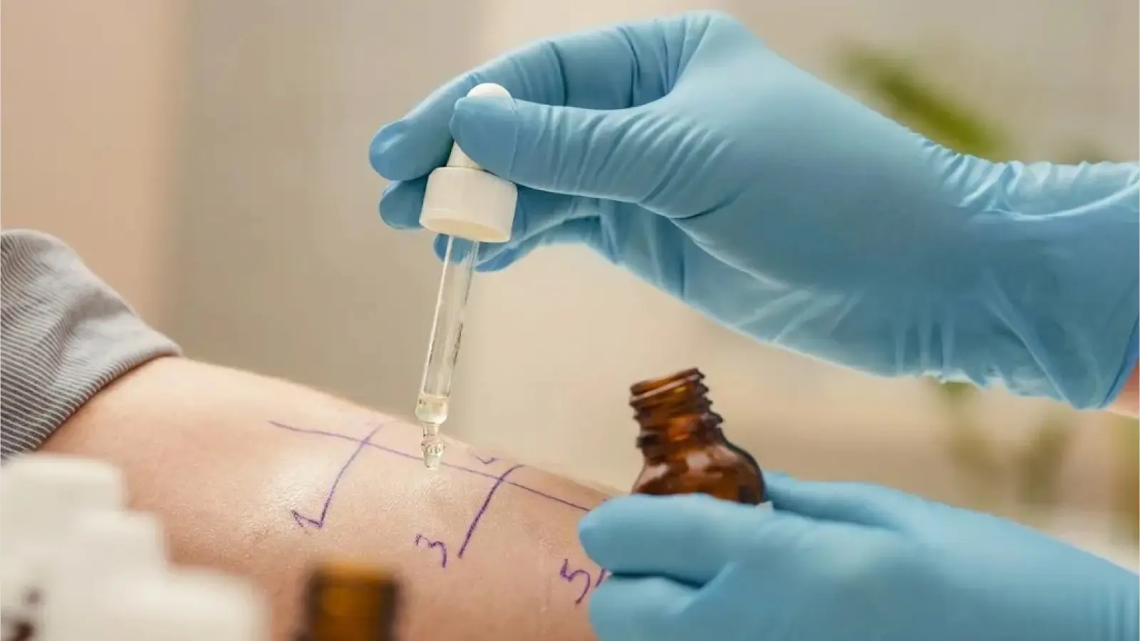 Durchführung eines Allergietests am Unterarm in der HNO Praxis Dr. med. Gudrun Fürst.