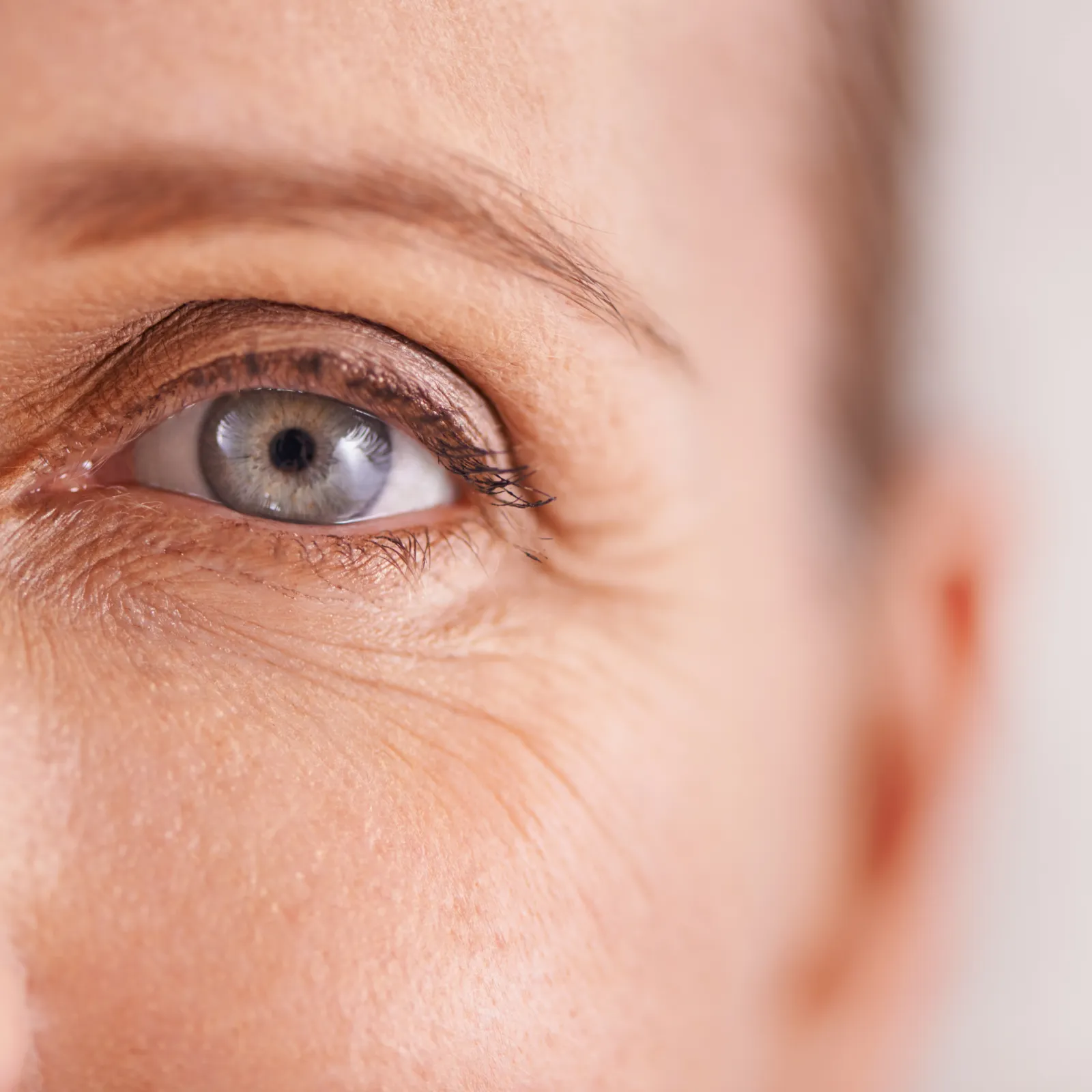 Nahaufnahme der Augenpartie mit feinen Mimikfalten vor einer Botulinum-Behandlung